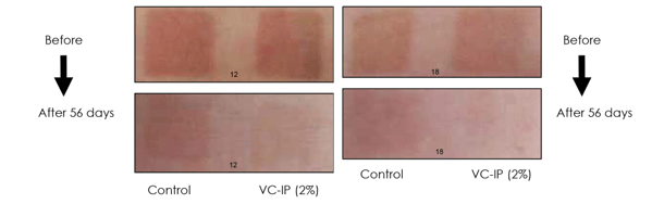 Vitamin C VC-IP improving pigmentation compared to control group over the span of 56 days